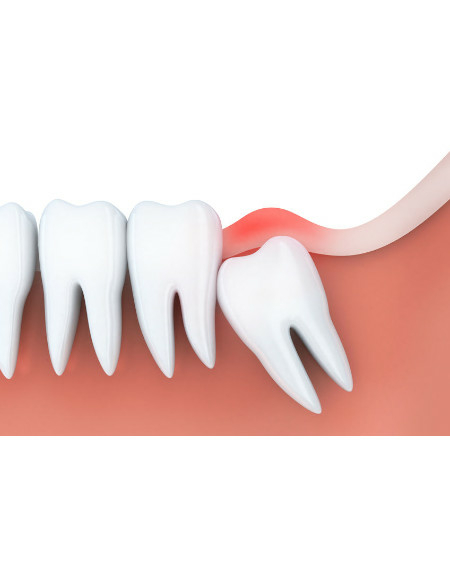 Weisheitszahnentfernung – wenn die Zahn-Nachzügler Ärger machen