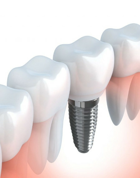 Zahnimplantat – ästhetisch ansprechende und funktionelle Lösung für den Ersatz verloren gegangener natürlicher Zähne