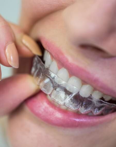 Aligner vs. Invisalign&reg; vs. konventionelle Zahnspange &ndash; was sind die Vorteile?