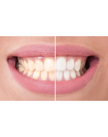 Mit Hausmitteln gegen Zahnverfärbungen – hilfreich oder schädlich? Das Team der Zahnboutique klärt auf