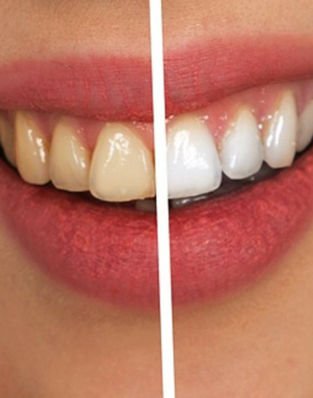 Wellness und Schönheit für Ihre Zähne nach einer zahnästhetischen Behandlung