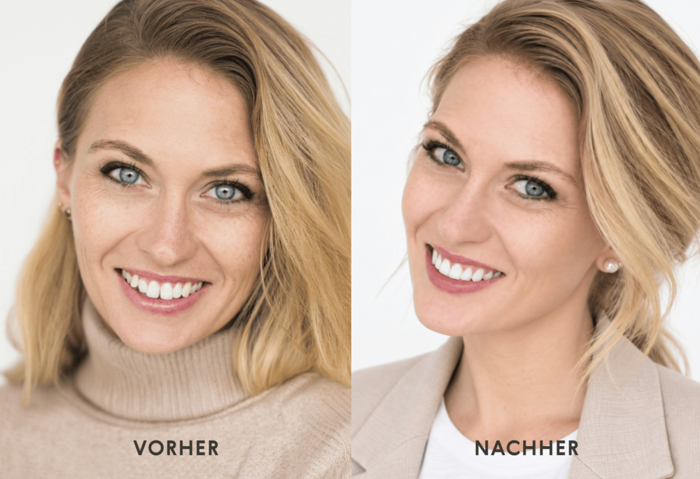 ALIGN&Eacute;-Behandlung - Vorher / Nachher Vergleich der Zahnstellung durch die Zahnbegradigung mit Alignern in Z&uuml;rich
